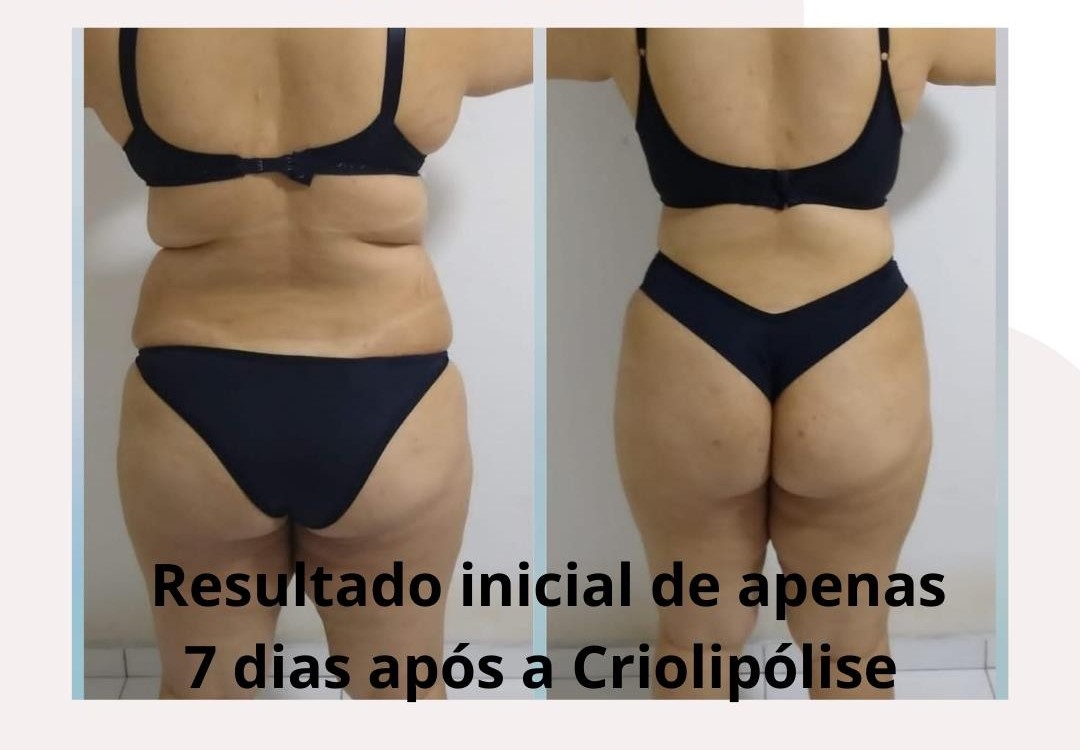 Evolução do tratamento de crio - Foto 1